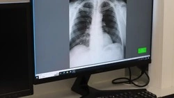 Специалисты Роспотребнадзора напомнили чернянцам о необходимости профилактики туберкулёза